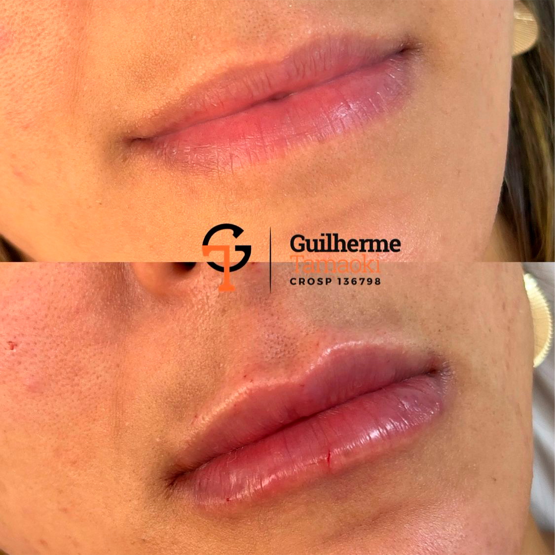 protese-03 copiar 10