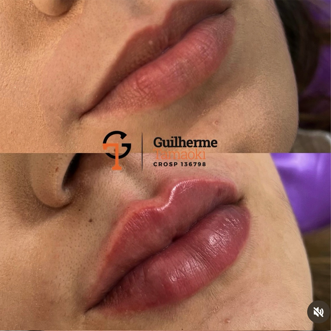 protese-03 copiar 11